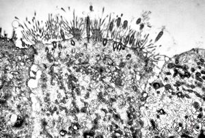 M,18y. | immotile cilia syndrome - bronchus M,18y. | immotile cilia syndrome - bronchus